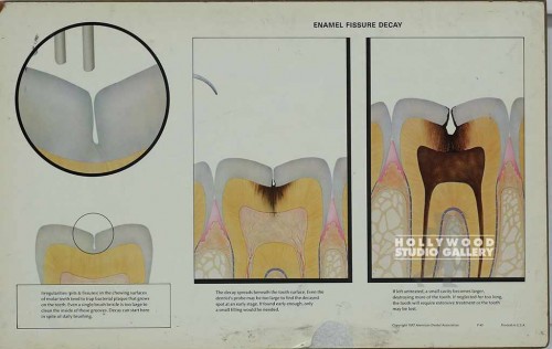11x18 Tooth Fissure Decay Unfrmd